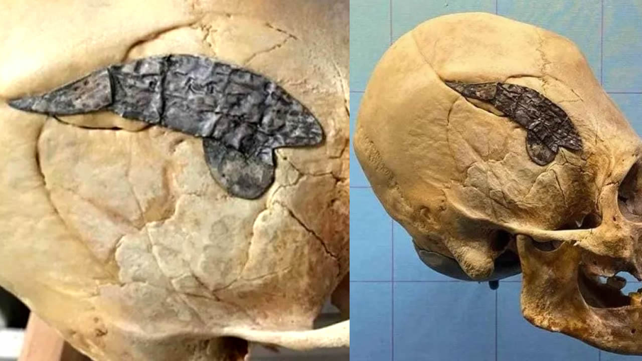 Hallado un cráneo alargado de 2.000 años con una pieza de metal implantada